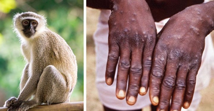 TƏBİB: "Meymun çiçəyi"nə qarşı vaksinasiya mövcuddur"